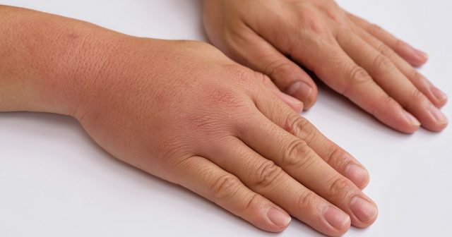 Пораженные участки кожи могут опухать и краснеть