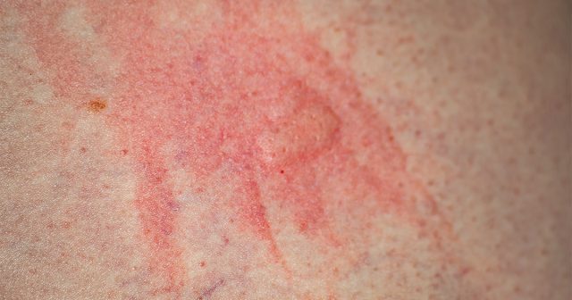 Укусы клопов могут быть одиночными или в виде хаотичных групп Укусы клопов могут быть одиночными или в виде хаотичных групп