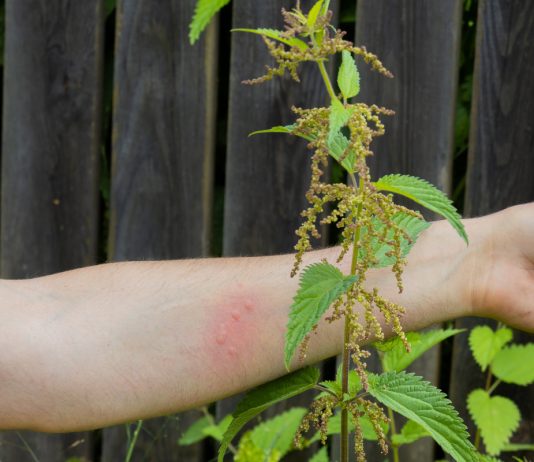 Отдых без ожогов и раздражений: защищаемся от последствий контакта с природой